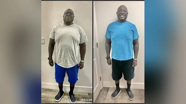 Before and after photo of a Healthy Weight Loss 4 U patient; individual results vary