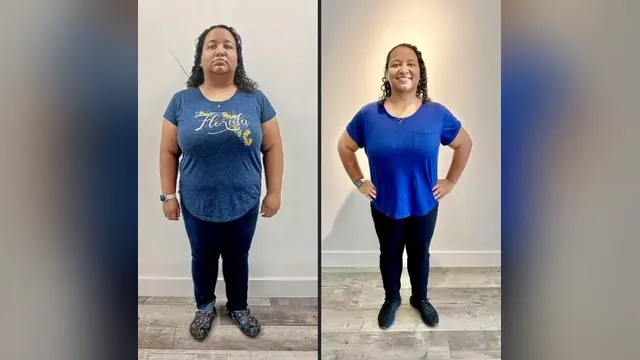 Before and after photo of a Healthy Weight Loss 4 U patient; individual results vary